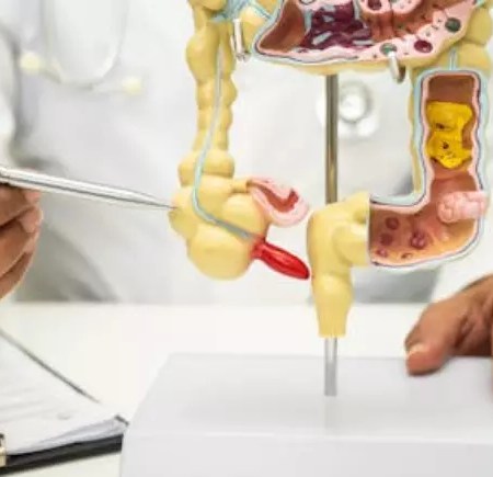 O câncer de apêndice é raro e difícil de detectar precocemente.