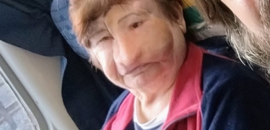 Superação e prótese facial: o caso de Alaíde forato